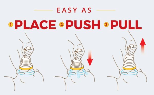 Choking Rescue Device