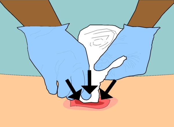 Kaolin Hemostatic Gauze for Wound Packing